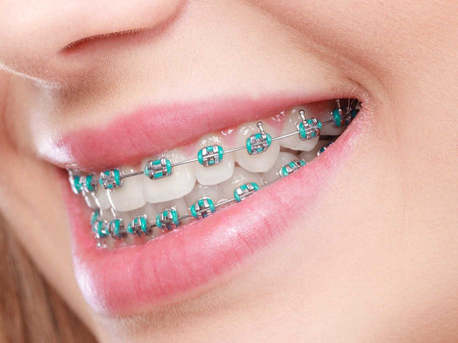 orthodontic care for braces in Clermont, FL
