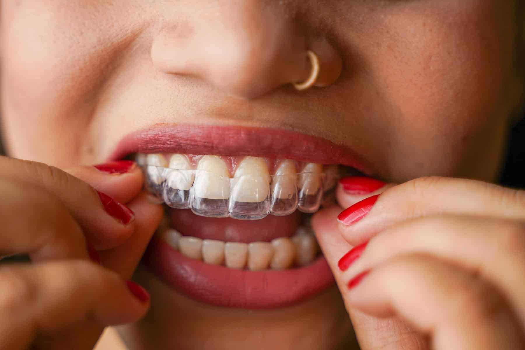 Invisalign GO dentist in Clermont, FL